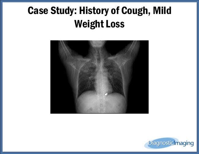 History of Cough, Mild Weight Loss