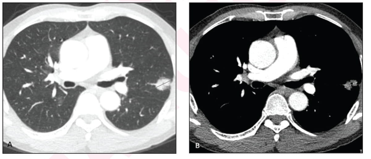 CT Study Links Better Five-Year Prognosis with Minor Ground Glass Opacity Component in NSCLC Lung Nodules 