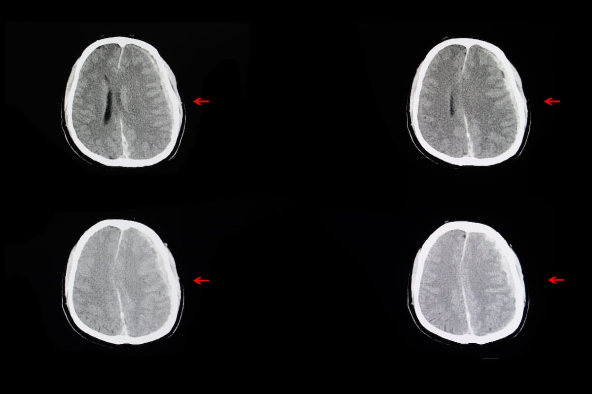 FDA Clears AI Advance for Detecting Intracranial Hemorrhage on Non-Contrast CT