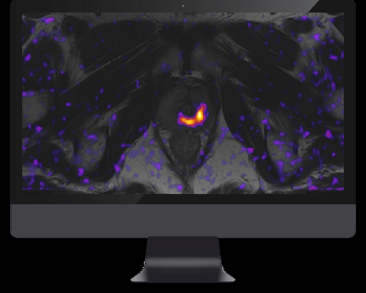 Can a New Prostate MRI Software Have an Impact?