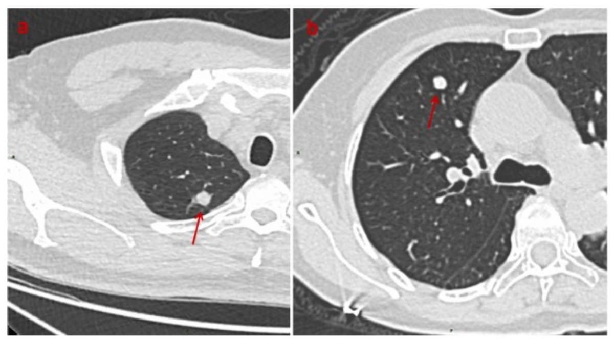 Can Deep Learning Models Improve CT Differentiation of Small Solid Pulmonary Nodules?