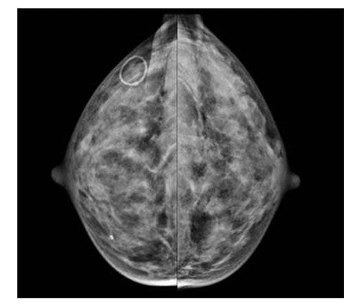 Breast Density Estimations in Standard-dose, Synthetic Mammograms