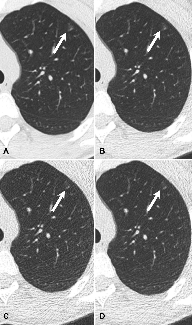 CT Dose for Pulmonary Nodule Detection: How Low Can It Go?