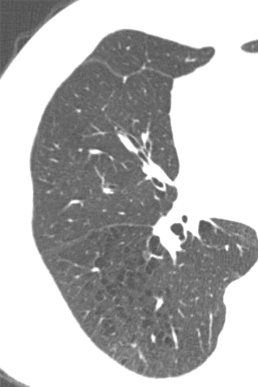 Emphysema Evidence on CT Can Predict Disease Progression in Smokers