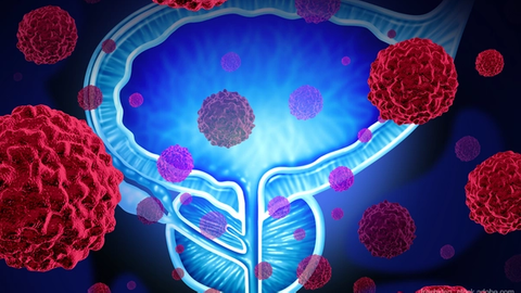 FDA Approves Tumor-Based MRI Contrast Agent for Prostate Cancer Detection