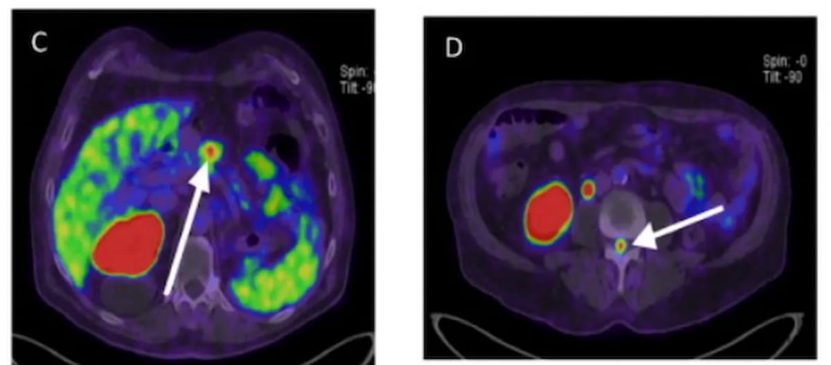 Meta-Analysis Assesses Impact of PSMA PET/CT for Staging of Renal Cell Carcinoma