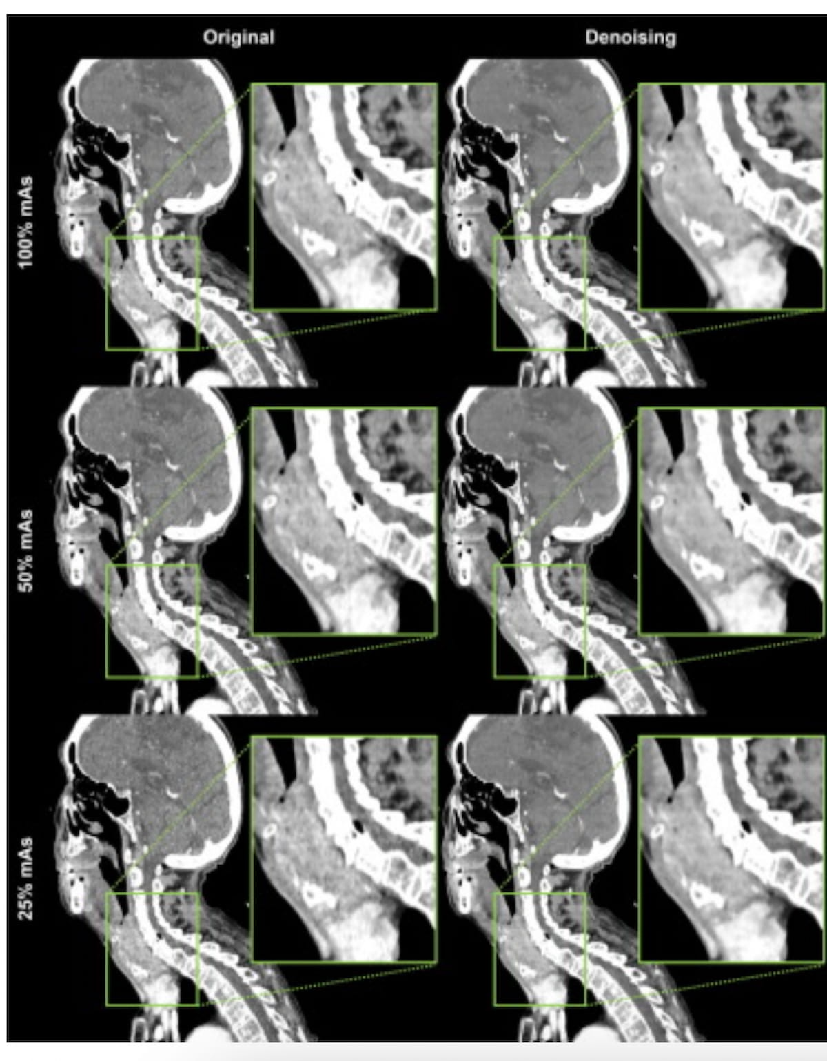 AI-Based Denoising for Neck CT May Facilitate Reductions in Radiation Dosing 