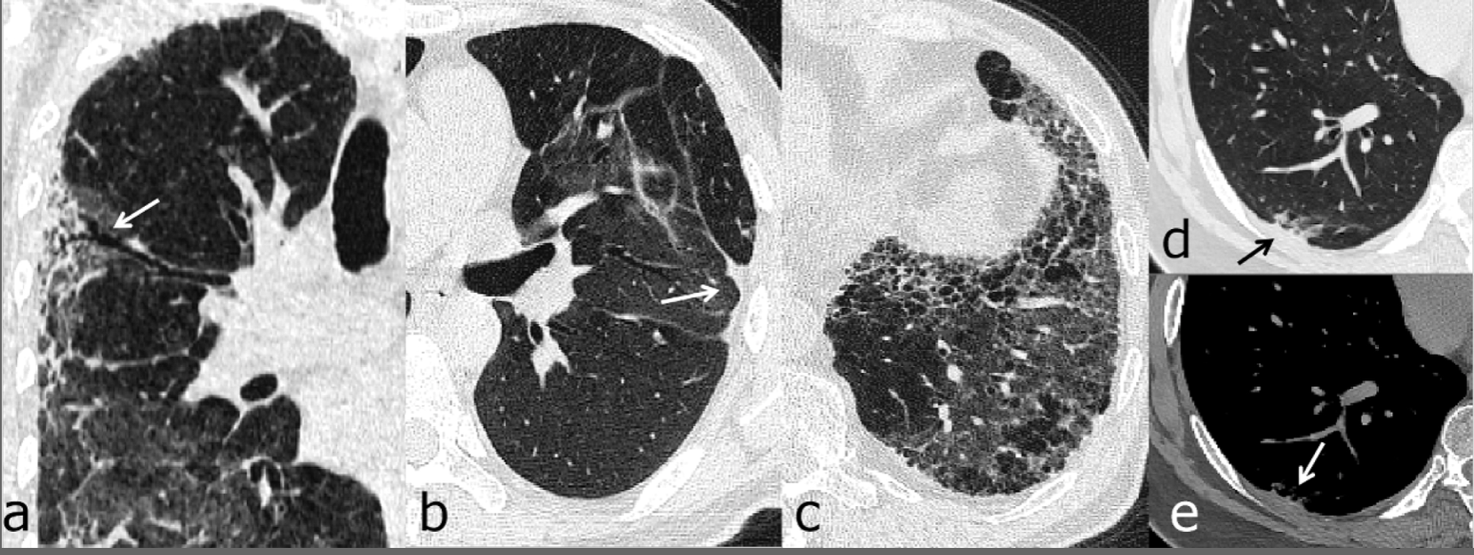 Post-COVID-19, CT Reveals Potentially Lifetime Lung Damage in One-Thirds of Patients