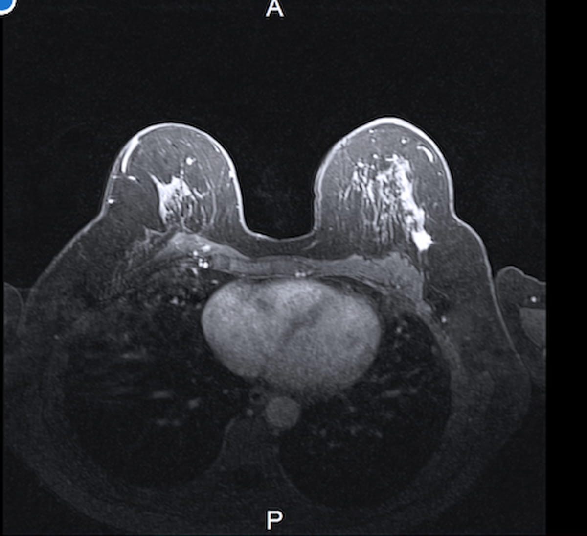 Preoperative Breast MRI Identifies Additional Cancer in Nearly 25 Percent of Young Women with Breast Cancer