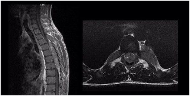 Image IQ: 25-year-old, Progressive Lower Extremity Weakness