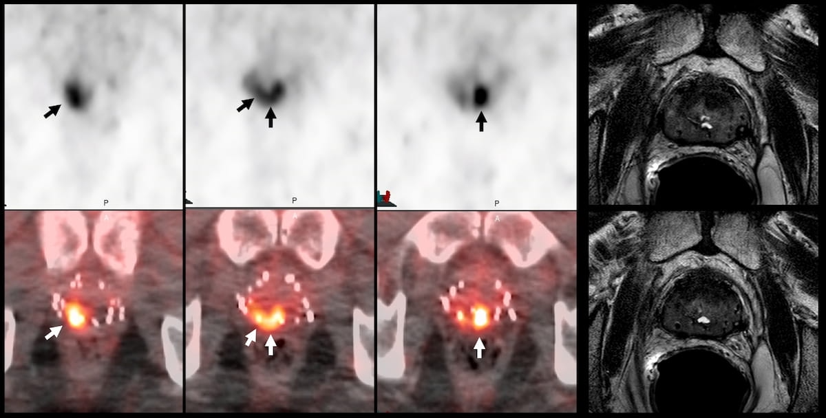 Can an Emerging PET Radiotracer Be a Viable Alternative to Multiparametric MRI for Detecting Prostate Cancer Recurrence?