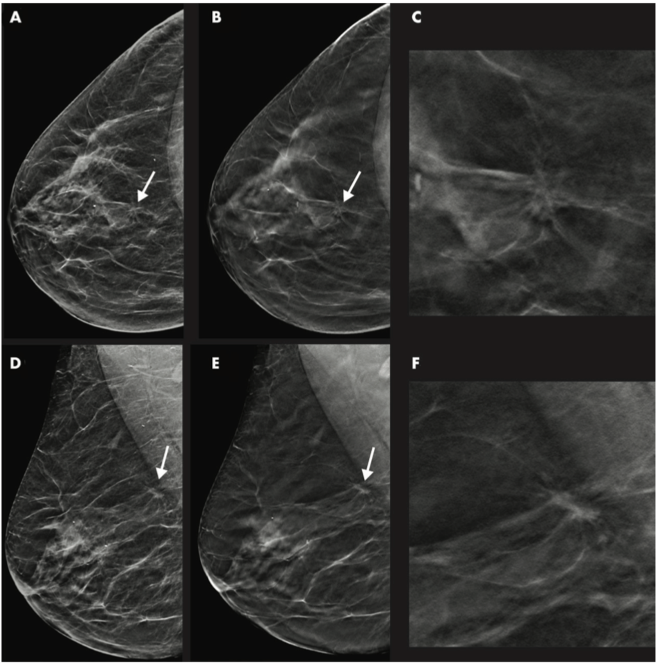 Breast Cancer Detection Better with DBT/Synthetic Mammography Combo