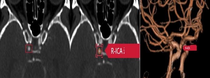 Could AI Improve Detection of Intracranial Aneurysms on CT Angiography?