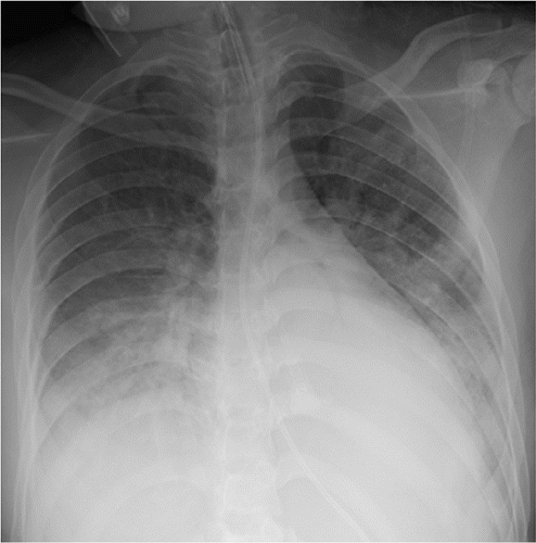 Figure 1- 16-year-old female with tuberous sclerosis and positive COVID-19 RT-PCR test who presented with acute hypoxic respiratory distress. Frontal chest radiograph shows bilateral lower lung zone-predominant consolidation and ground-glass opacities, which is typical CXR findings of pediatric COVID-19 pneumonia. Also noted are endotracheal tube and nasogastric tube. Courtesy: Radiology: Cardiothoracic Imaging