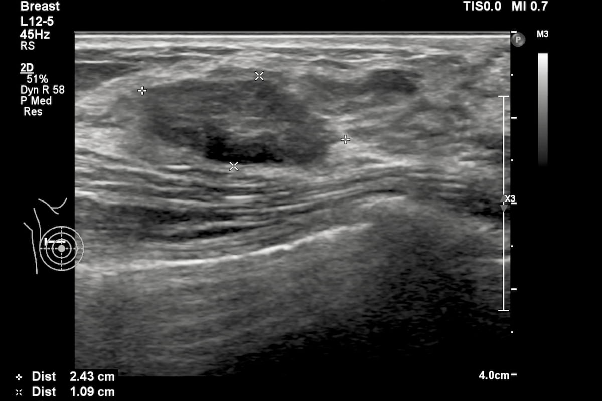 ECR Study Finds Mixed Results with AI on Breast Ultrasound