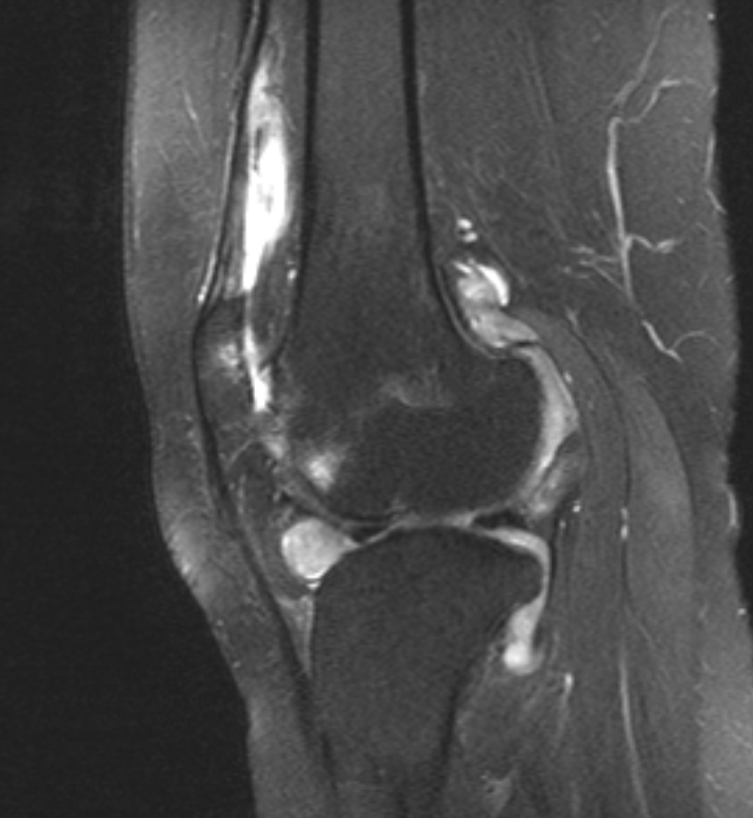 Image IQ: 11-year old Female with Bilateral Knee Swelling