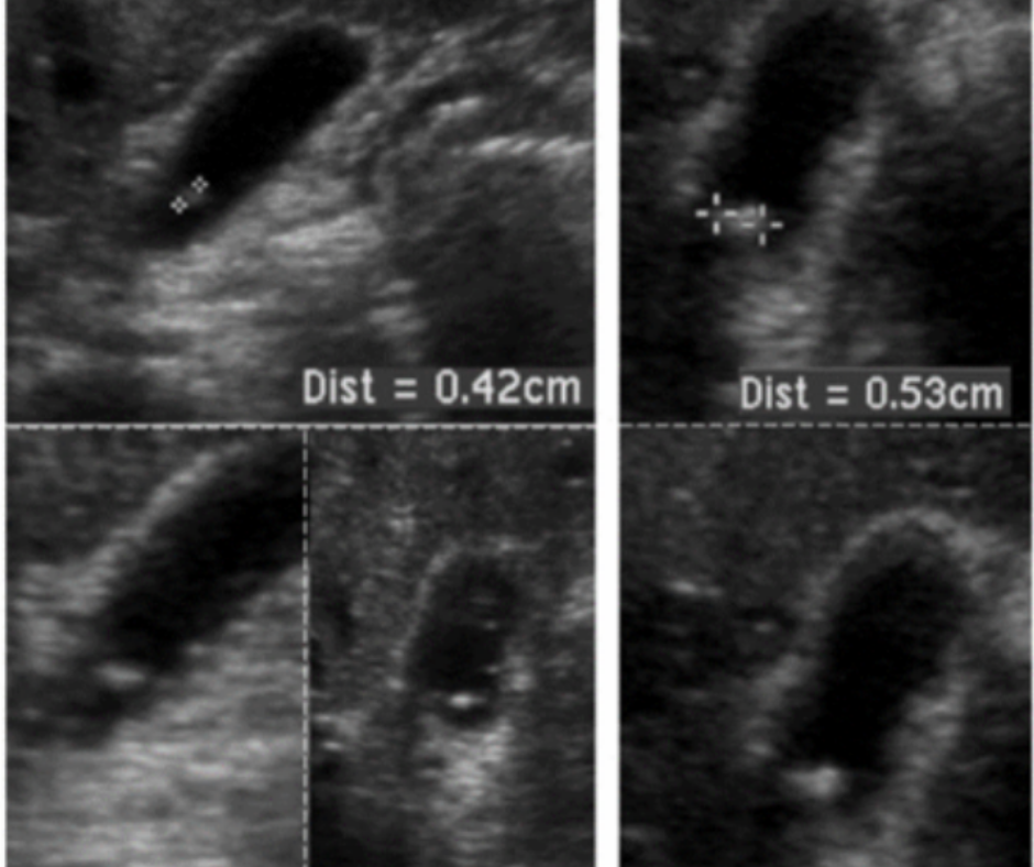 New Ultrasound Study of Incidentally Detected Gallbladder Polyps Raises Questions About Current Guidelines