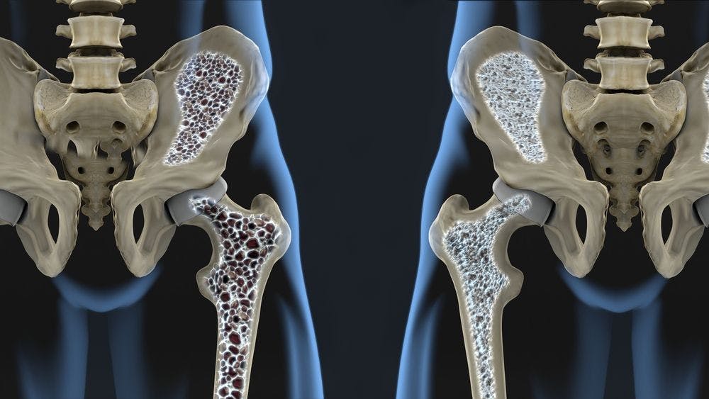 AI Outperforms Radiologists in Detecting Fractures in Patients At-Risk for Osteoporosis