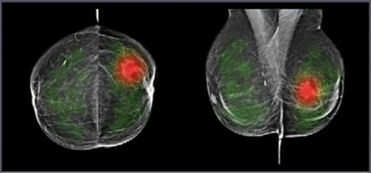 What a New Study Reveals About AI, Bias, and Mammography Assessment