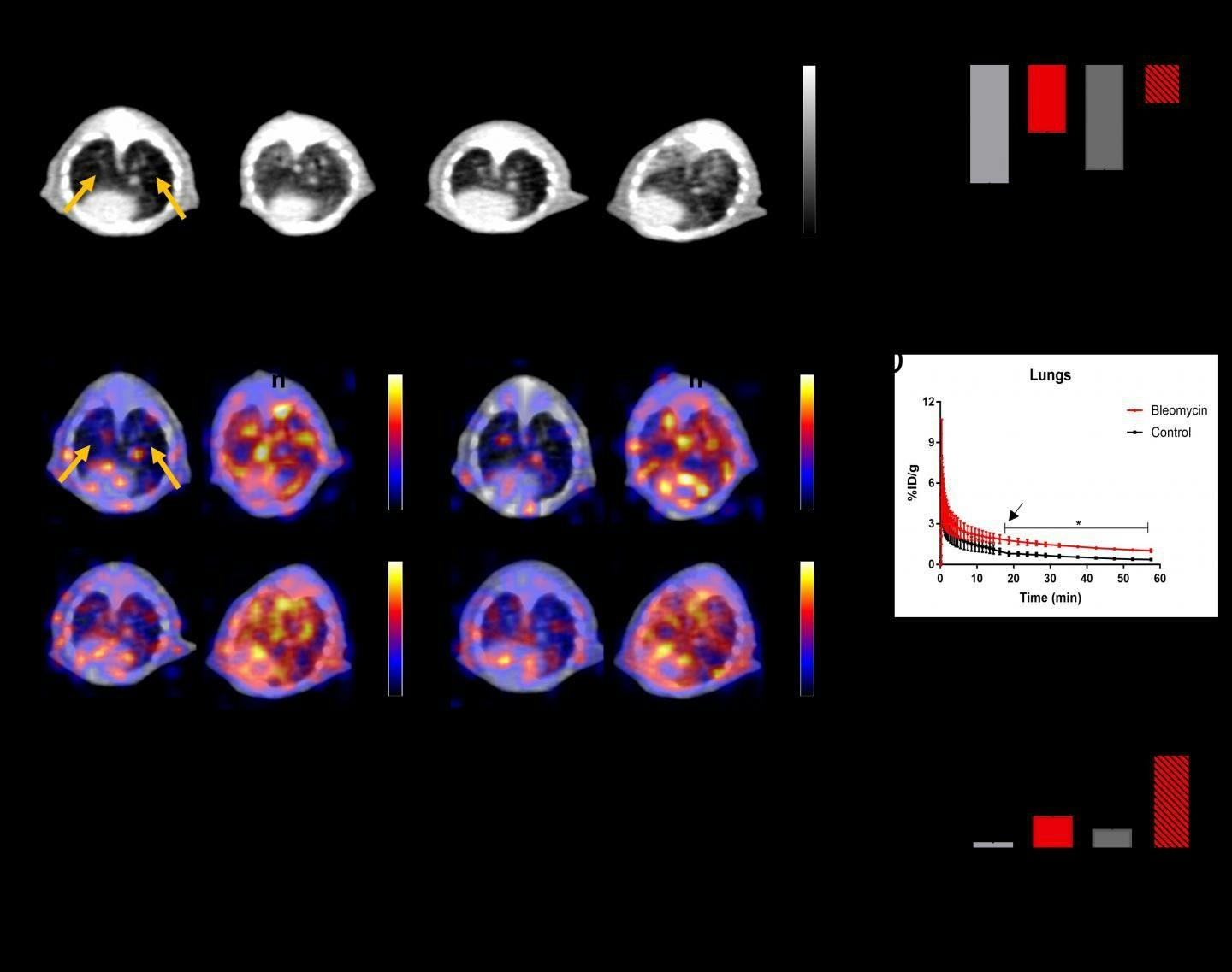 A) Axial CT images through the mouse lungs at 7 and 14 days after intratracheal administration of bleomycin or saline (as a control), demonstrating increased lung fibrosis in the bleomycin group (white arrows). (B) CT attenuation histograms in Hounsfield units (HU) after lung segmentation demonstrate increased attenuation in the lungs in the bleomycin group than the control group (p <0.05), consistent with increasing fibrosis (n=3). (C) Representative axial PET/CT fusion images at 20 and 60 min demonstrating increased FAPI uptake in the lungs of the bleomycin group (white arrows) with no significant uptake in the control group (yellow arrows). (D) Time-activity curve of lung uptake ROI analysis demonstrating higher FAPI uptake in the lungs of the bleomycin group than the control (p < 0.05), 14 days after bleomycin (n=3). (E) Ex vivo biodistribution data of lung tissue demonstrating higher radiotracer uptake in the lungs of the bleomycin group than the control (n=3). *p<0.05, **p<0.01.

Credit: Image created by CA Ferreira et al., University of Wisconsin-Madison, Madison, WI.


