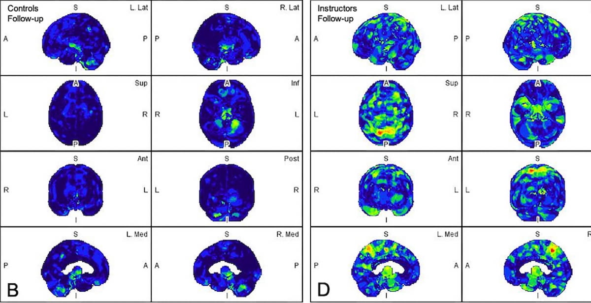 Brain PET Study Suggests Link Between Early Amyloid Accumulation and Repetitive Subconcussive Trauma