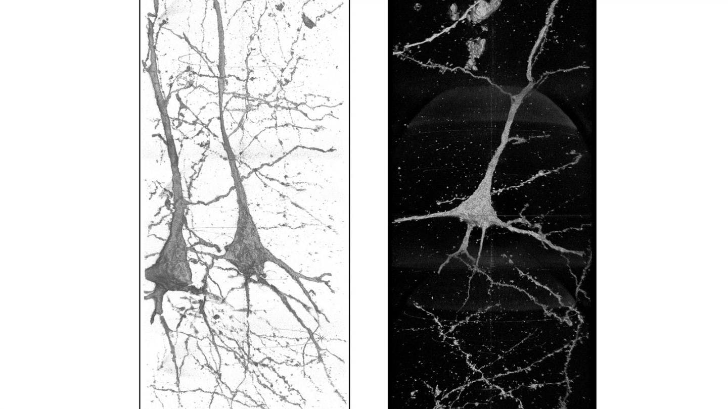 X-ray Reveals Neuron Differences in Patients with Schizophrenia