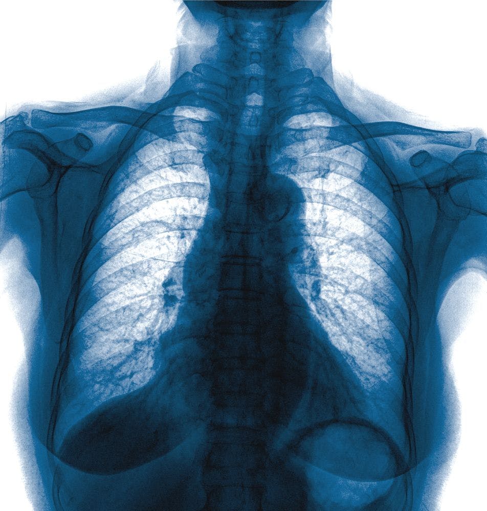 Daily Chest X-Rays the Norm for Many Patients on Mechanical Ventilation