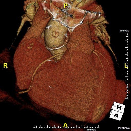 Image IQ: 74-year-old, History of Aortic Valve Repair