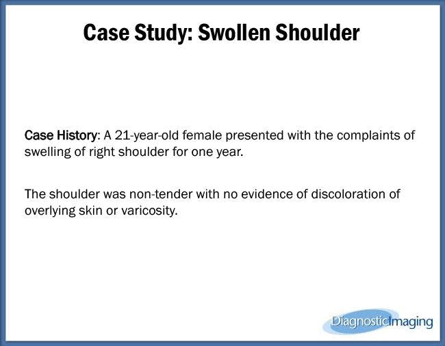 Swollen Shoulder