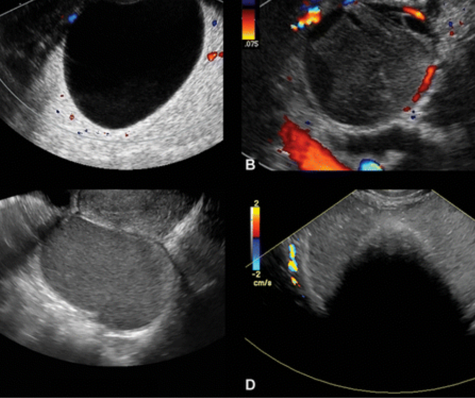 Could an Emerging Classification Scheme Streamline Ovarian Cancer Detection on Pelvic Ultrasound? 