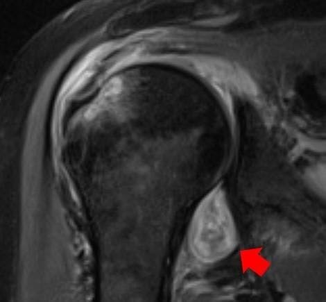 MRI image of a patient's shoulder. The red arrow points to inflammation in the joint. The COVID virus triggered rheumatoid arthritis in this patient with prolonged shoulder pain after other COVID-19 symptoms resolved.

CREDIT

Northwestern University