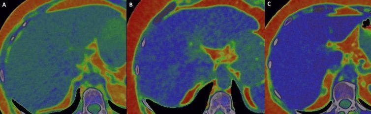 Could Photon Counting CT Supplant MRI for Imaging Assessment of Hepatic Steatosis?