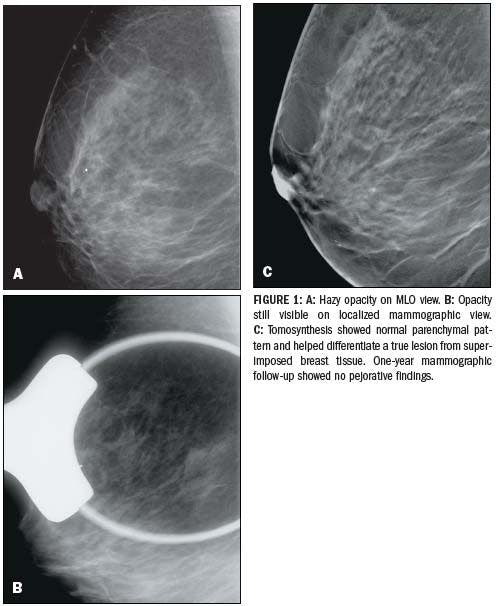Breast tomosynthesis tackles new challenges
