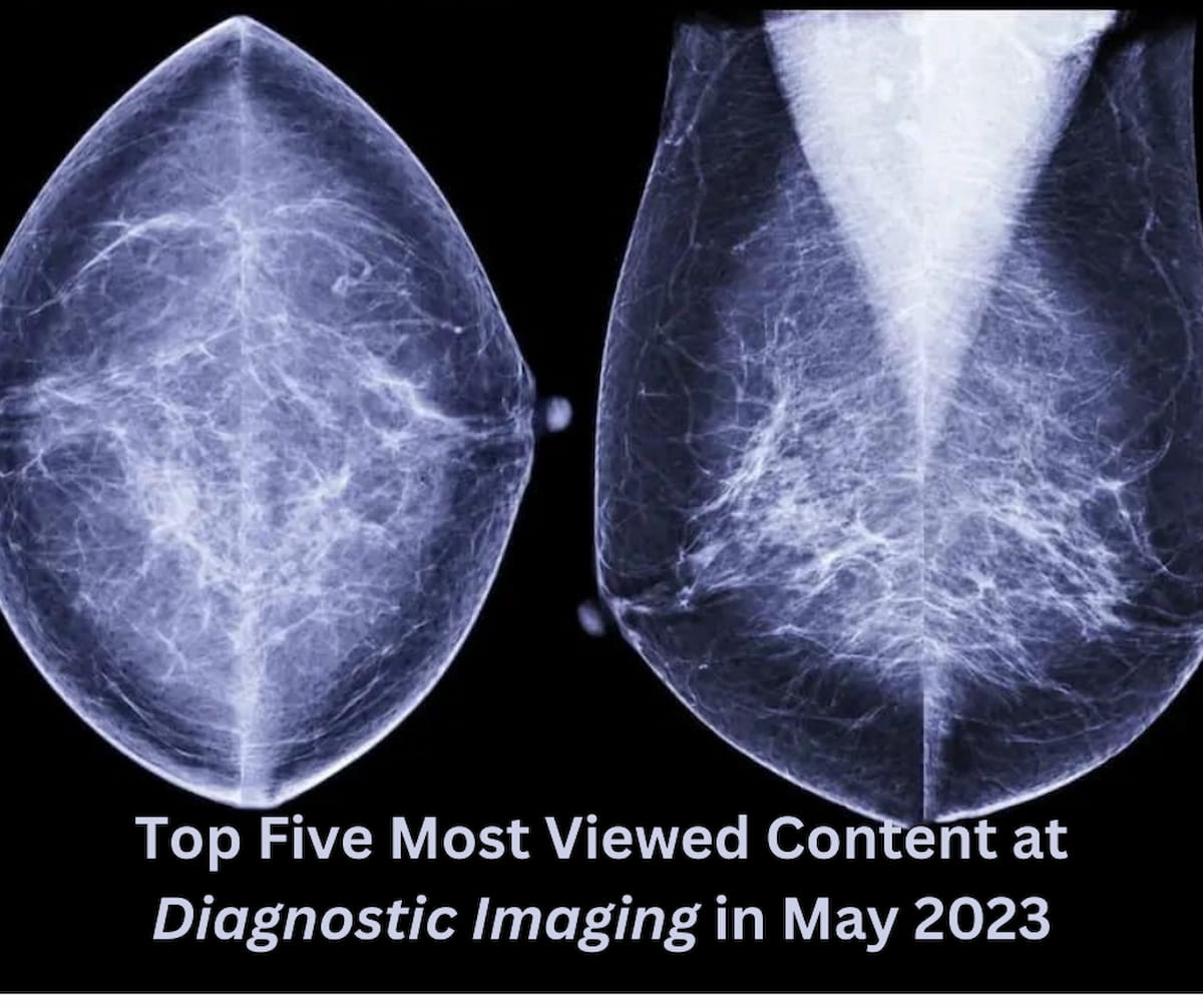 The Top Five Most Viewed Content at Diagnostic Imaging in May 2023