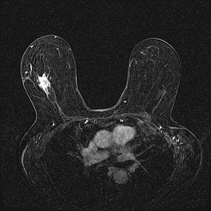 Image IQ: 72 year-old Female, Focal Asymmetry in Breast