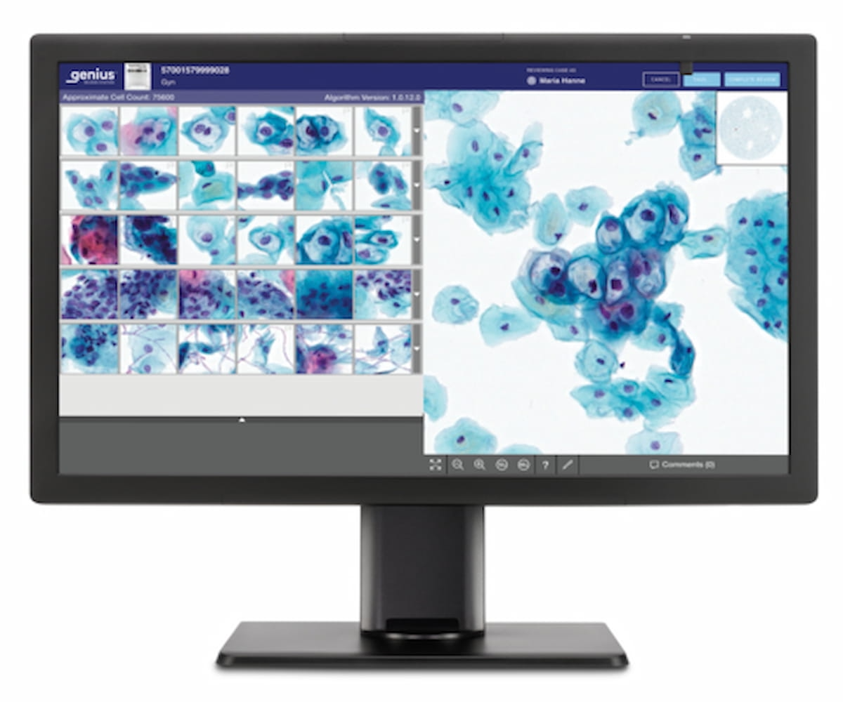 FDA Clears AI-Powered Digital Cytology Platform for Cervical Cancer