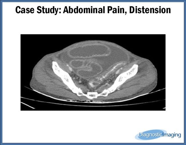 Abdominal Pain, Distension