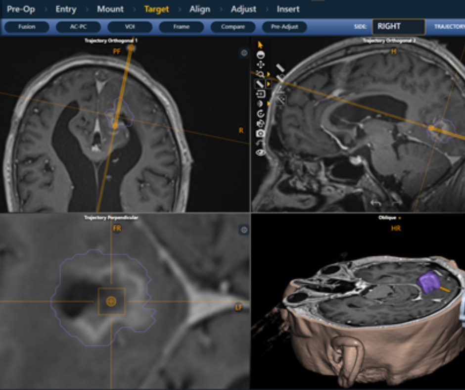 New Version of Adjunctive MRI Neuroimaging Software Gets FDA Nod