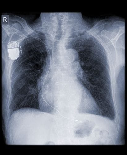 Pacemaker in x ray