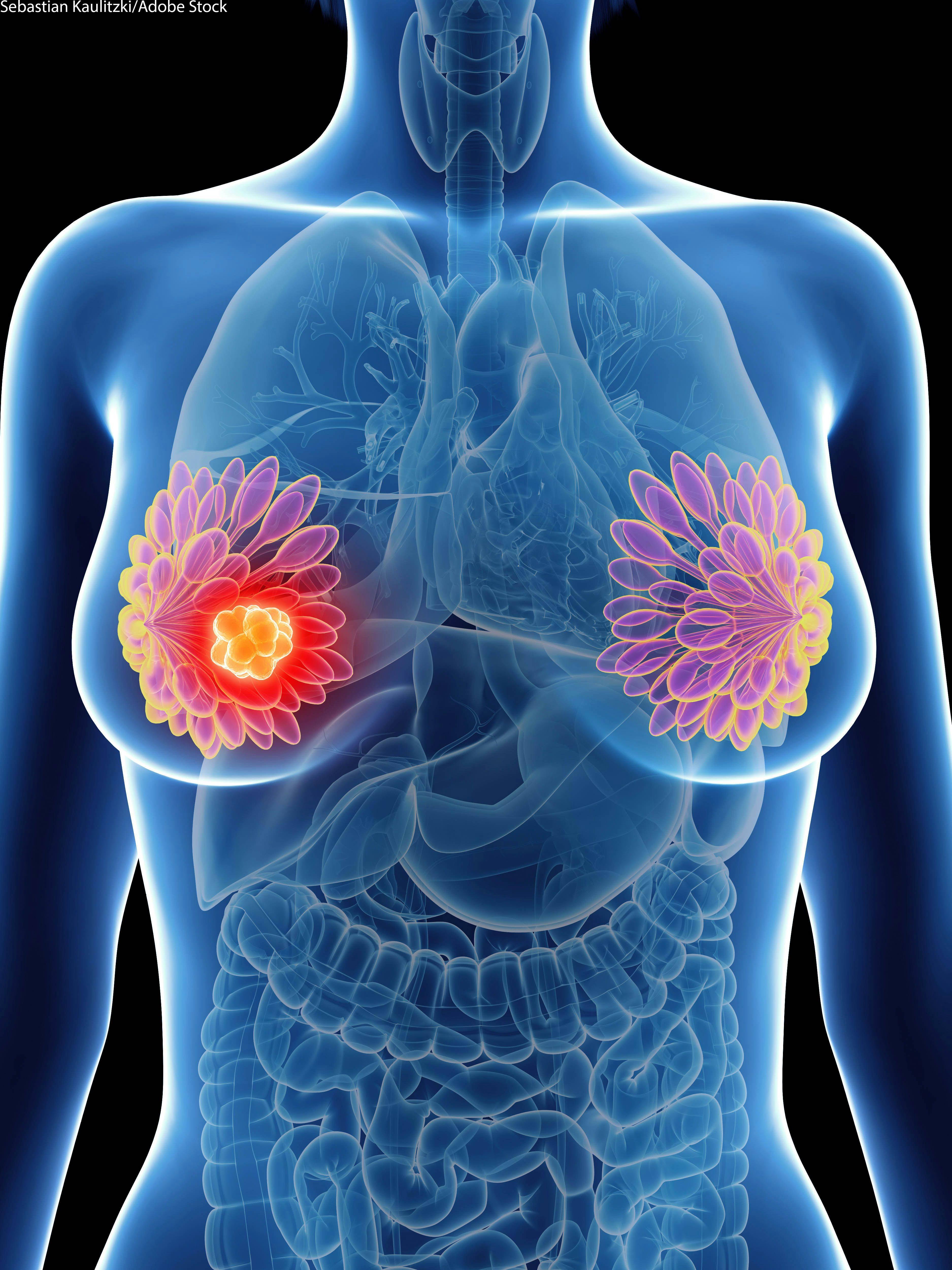 Post-BI-RADS 3 Mammogram Identifies Invasive Cancers