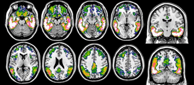 Emerging Neuroradiology Concepts: Could Tau-PET be a New Standard in Assessing Possible Alzheimer’s Disease?