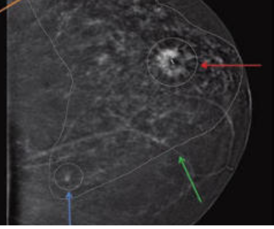 What a New Study Reveals About MRI-Guided Use Of Contrast-Enhanced Mammography