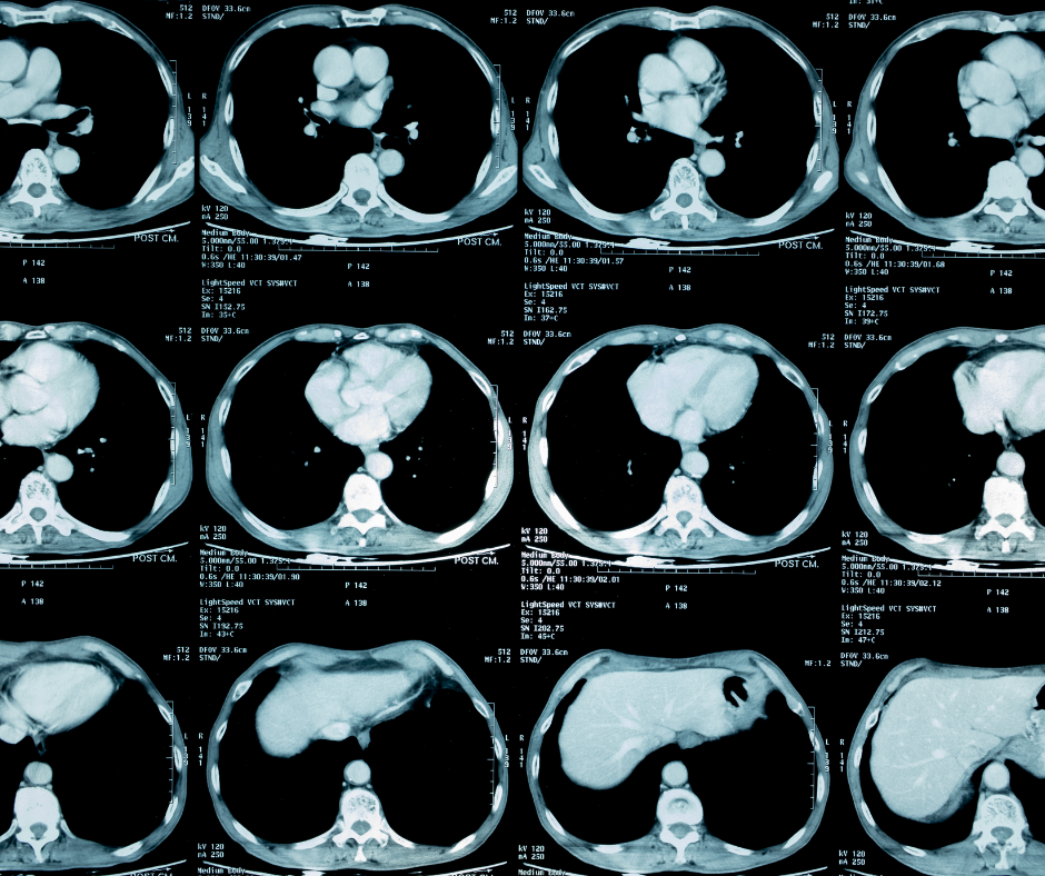Study Looks at Potential Impact of Expanded Eligibility for Low-Dose CT Lung Cancer Screening