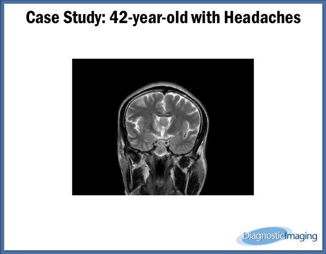 42-year-old with Headaches