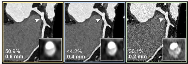 Study: Photon-Counting CT Improves Accuracy of Coronary Stenosis Assessment 