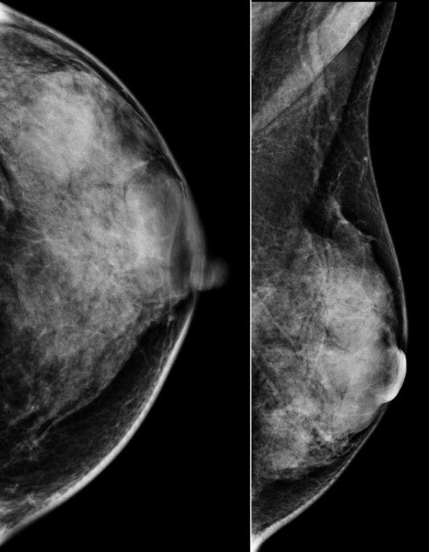 Image IQ: 52-year-old with Spontaneous Bloody Left Breast Discharge