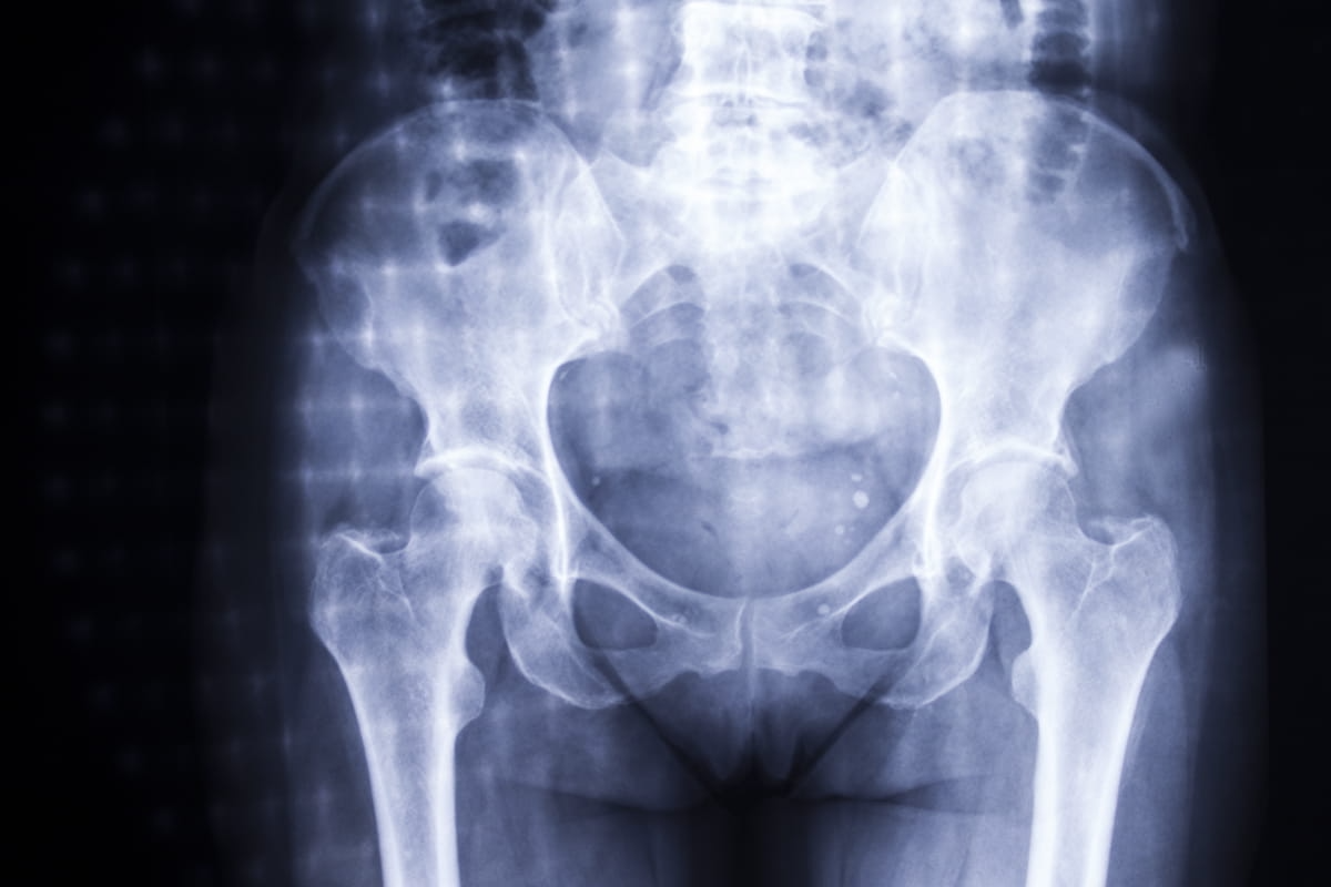 OsteoSight Gets FDA Breakthrough Device Designation for Bone Mineral Density Assessment on X-Rays