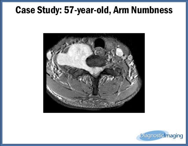 57-year-old, Arm Numbness