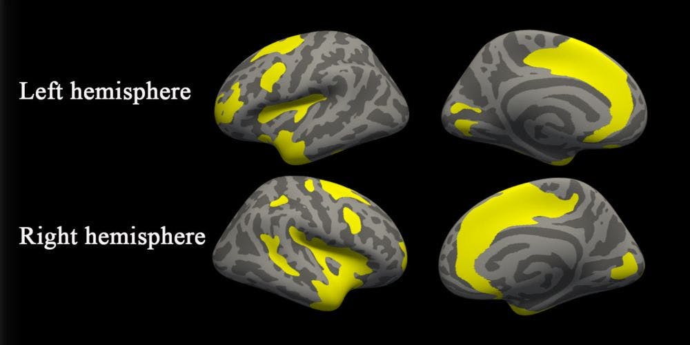 Brain MRI Shows Patterns in Patients with Depression, Anxiety