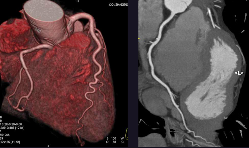Using Cardiac CTA Before TAVR to Assess Left Atrium Parameters May Predict Mortality